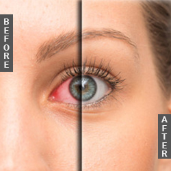 Glaucoma Before After