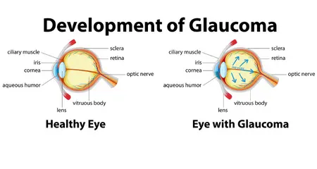 development of glaucoma