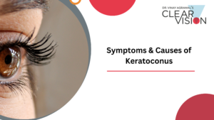 Read more about the article Symptoms & Causes of Keratoconus