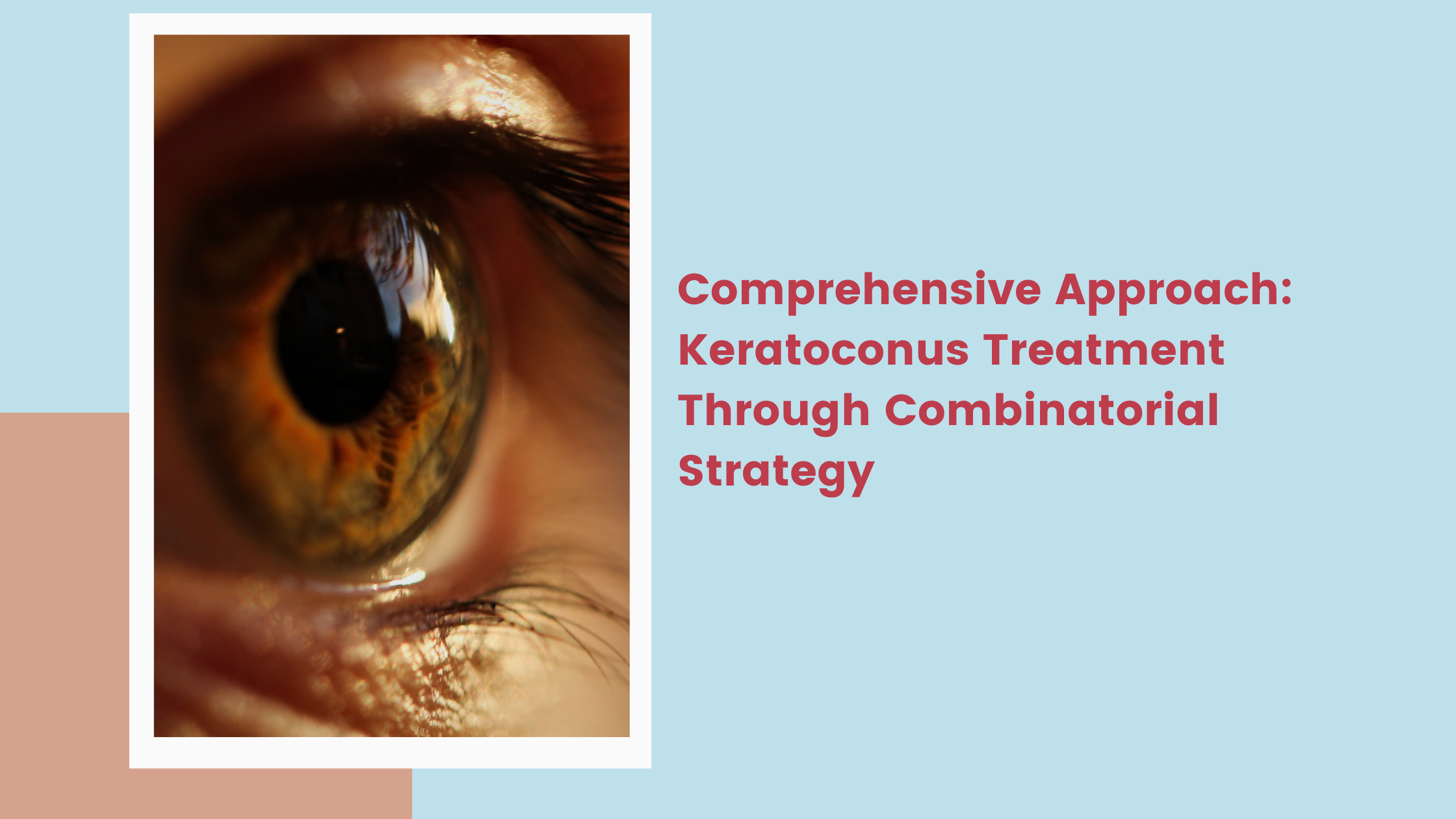 Read more about the article  Comprehensive Approach: Keratoconus Treatment Through Combinatorial Strategy
