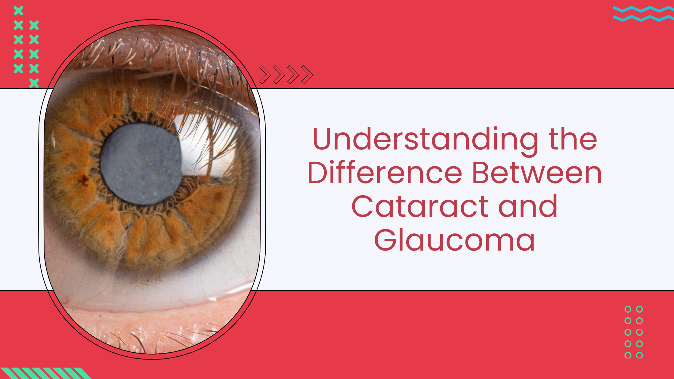 Read more about the article  Understanding the Difference Between Cataract and Glaucoma