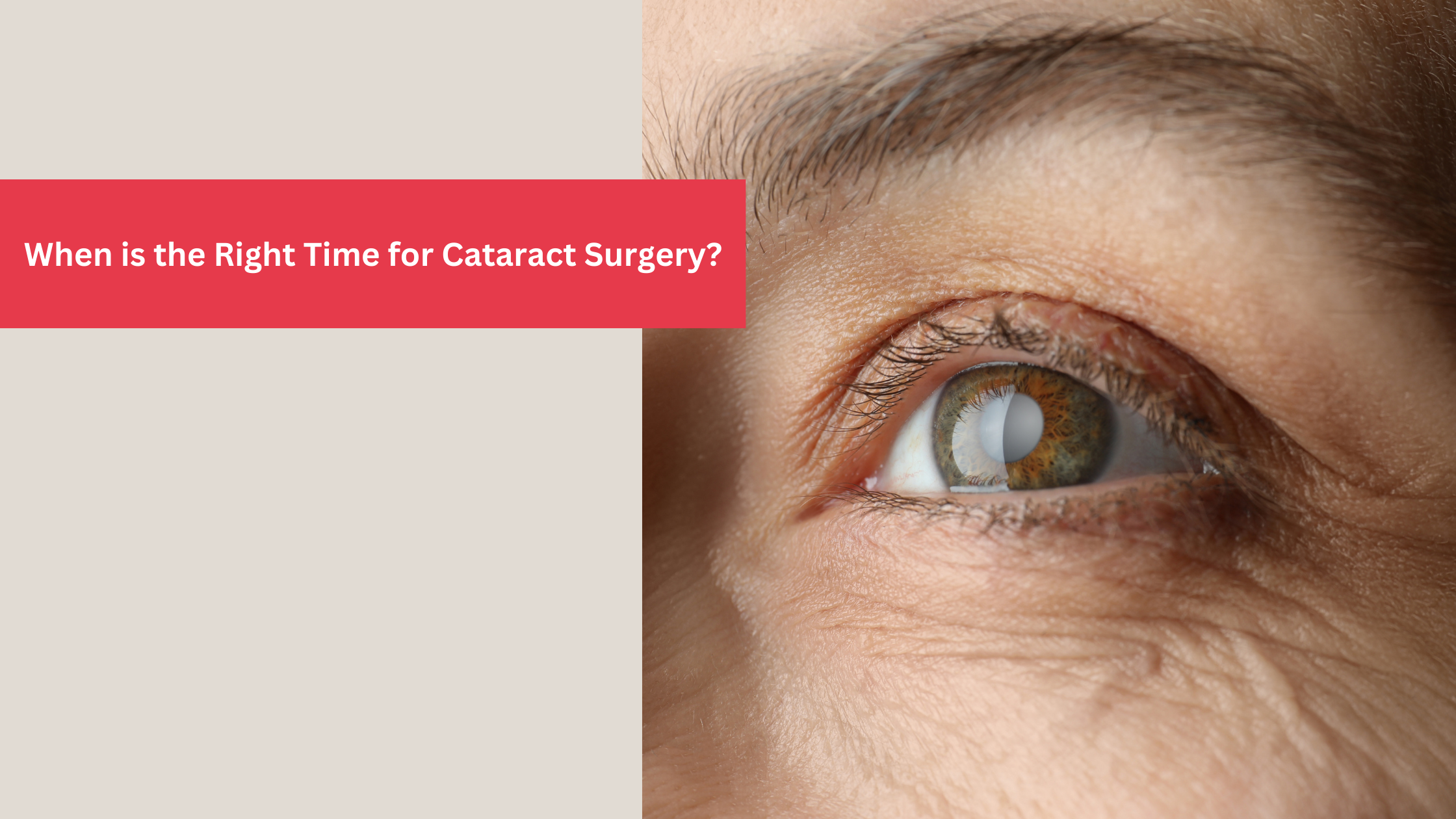 Read more about the article When is the Right Time for Cataract Surgery?