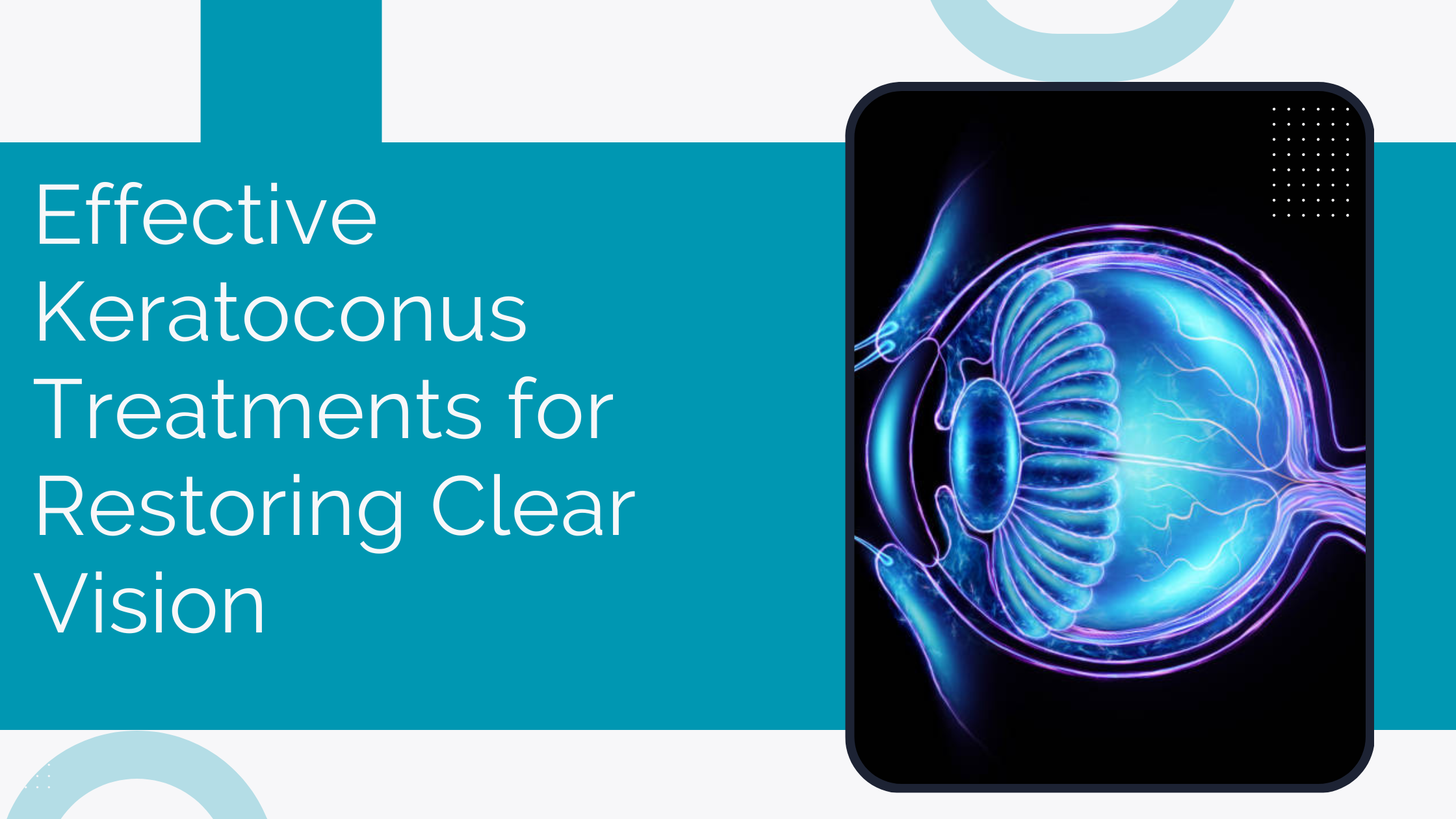 Read more about the article Effective Keratoconus Treatments for Restoring Clear Vision