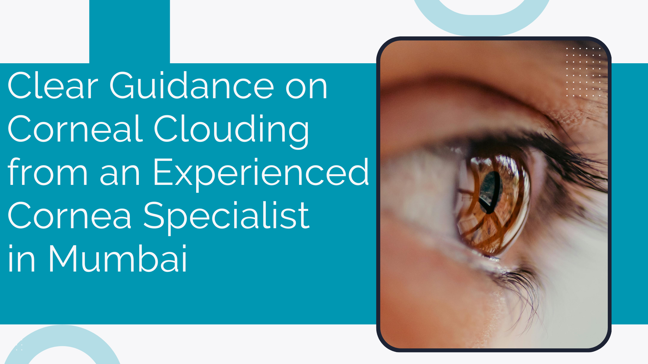 Read more about the article Clear Guidance on Corneal Clouding from an Experienced Cornea Specialist in Mumbai