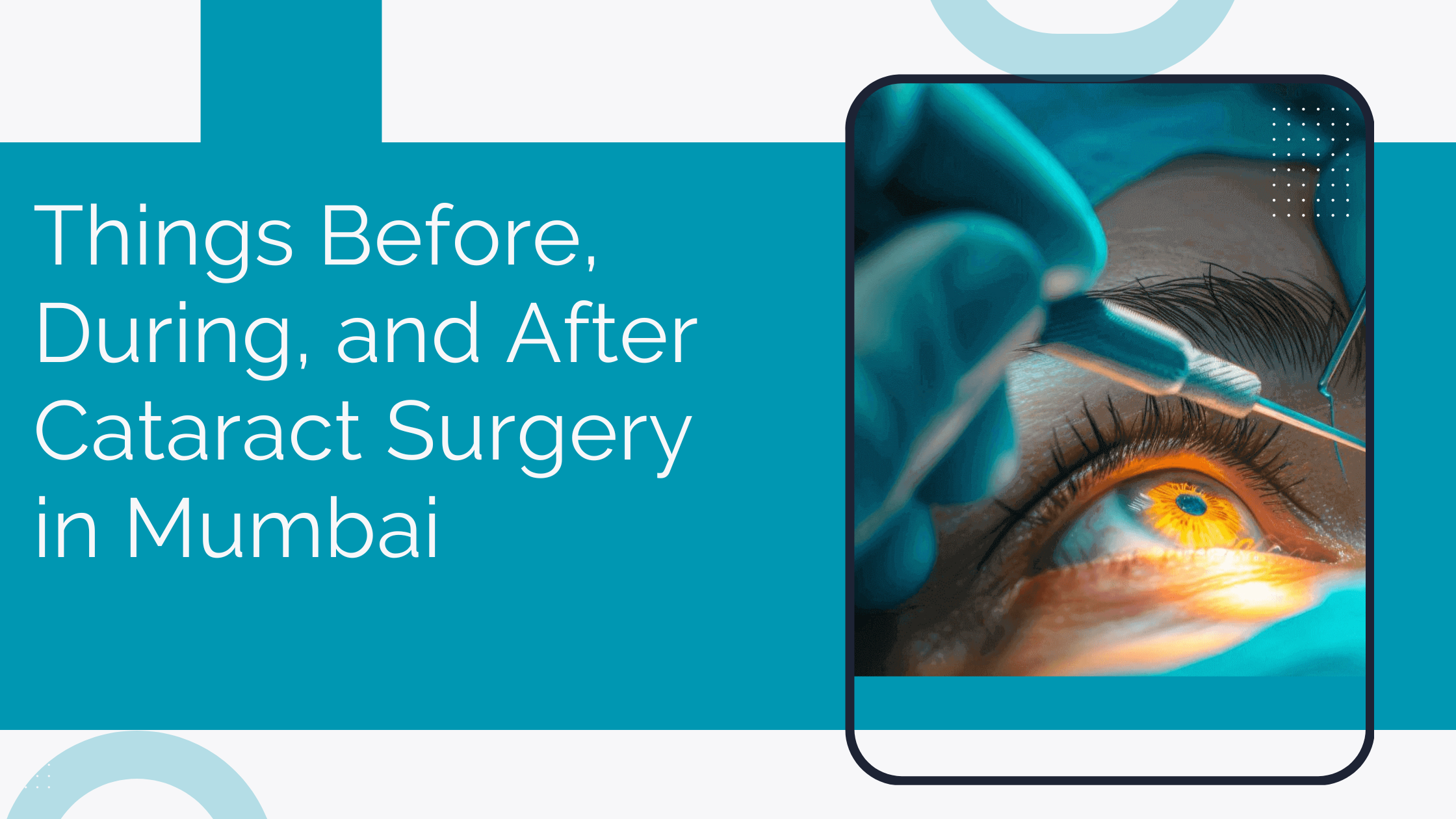 Read more about the article Things Before, During, and After Cataract Surgery in Mumbai