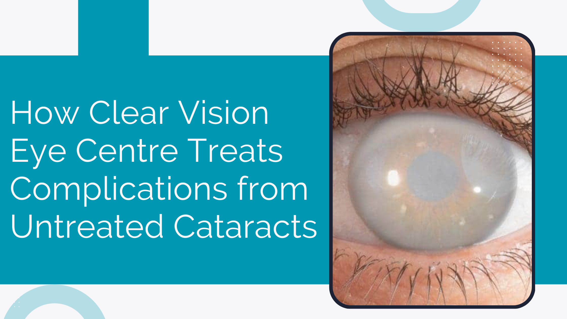How Clear Vision Eye Centre Treats Complications from Untreated Cataracts