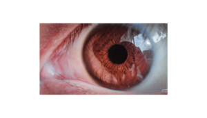 Keratoconus Early Stage