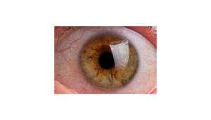 Keratoconus Moderate Stage
