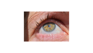 Keratoconus Severe Stage