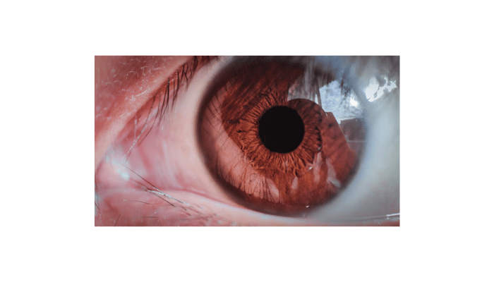 Keratoconus