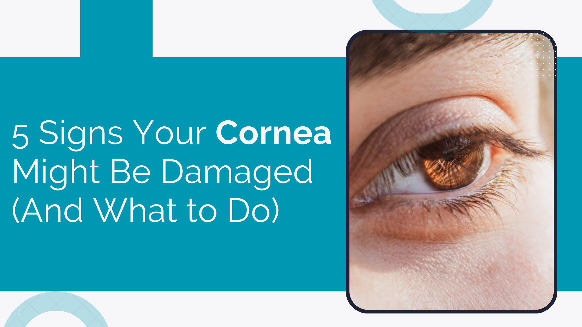 Home 17 5 Signs Your Cornea Might Be Damaged (And What To Do)