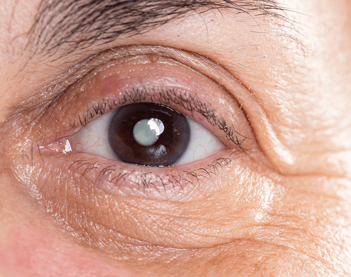 Cataract Care