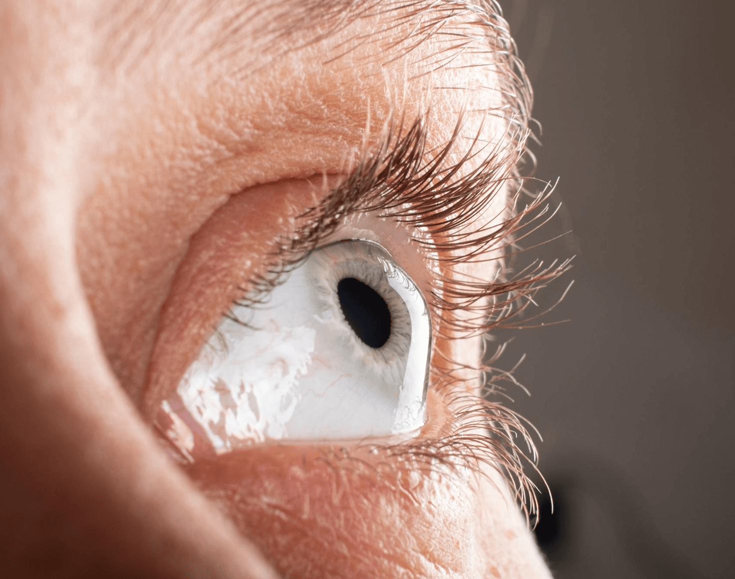 Cornea Keratoconus
