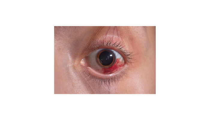 Corneal Abrasions and Ulcers