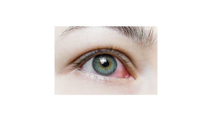 Dry Eye Syndrome