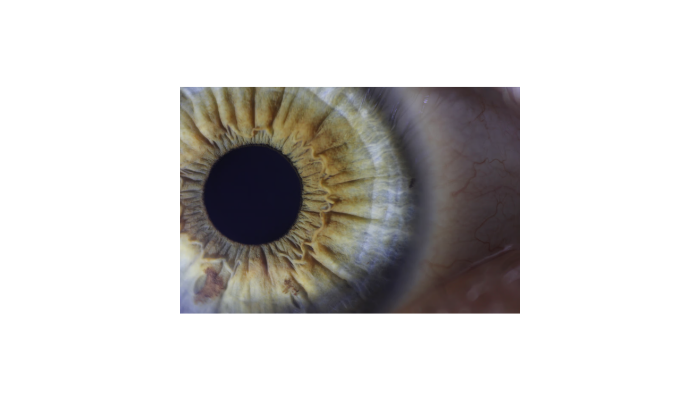 Fuchs’ Dystrophy
