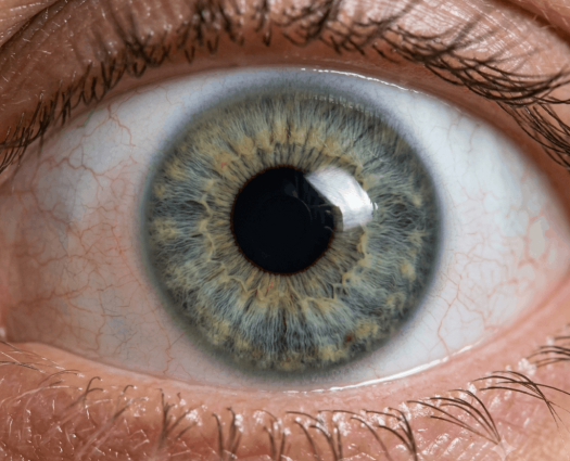 Keratoconus 12 (1)