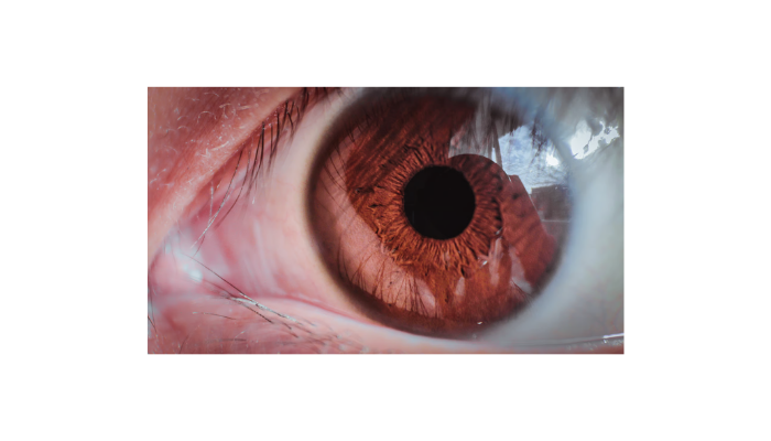 Keratoconus
