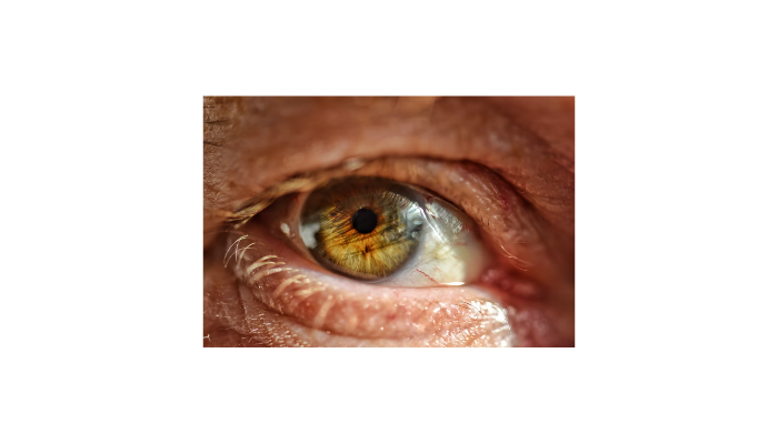 Understanding The Mechanics Of Keratoconus